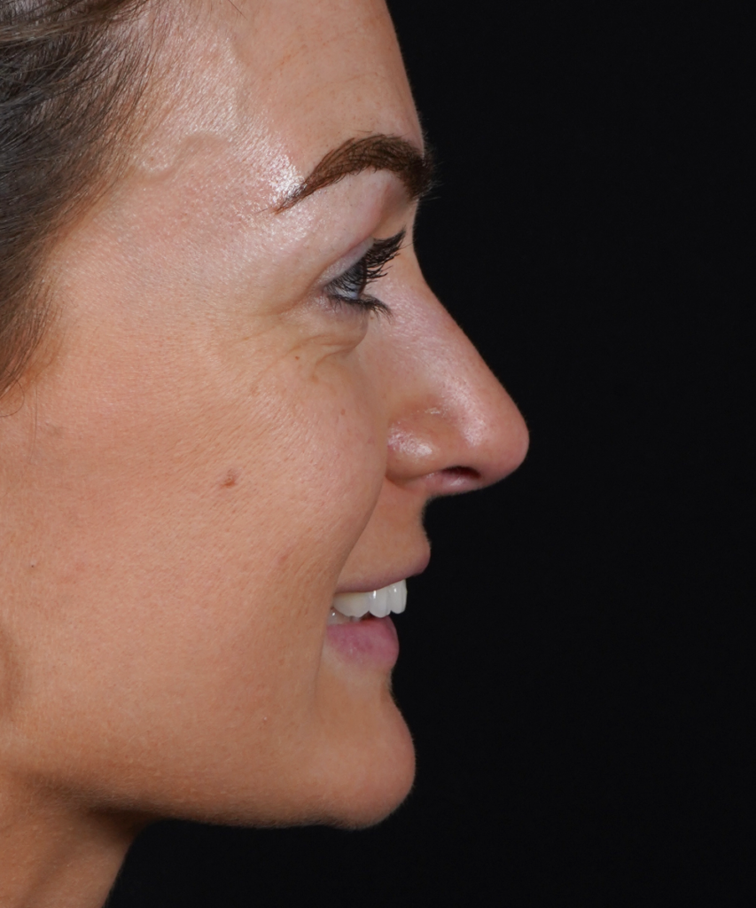 After smile