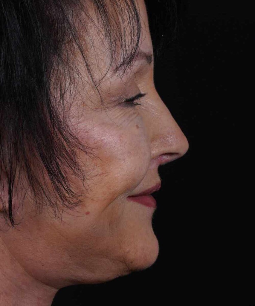After lateral smiling