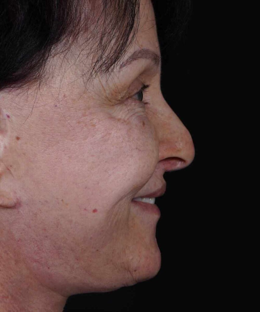 Before lateral smiling