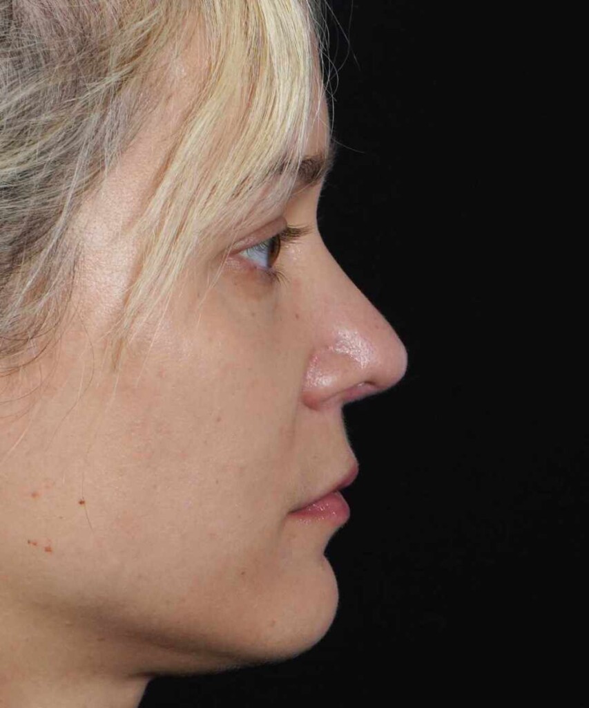 After lateral right