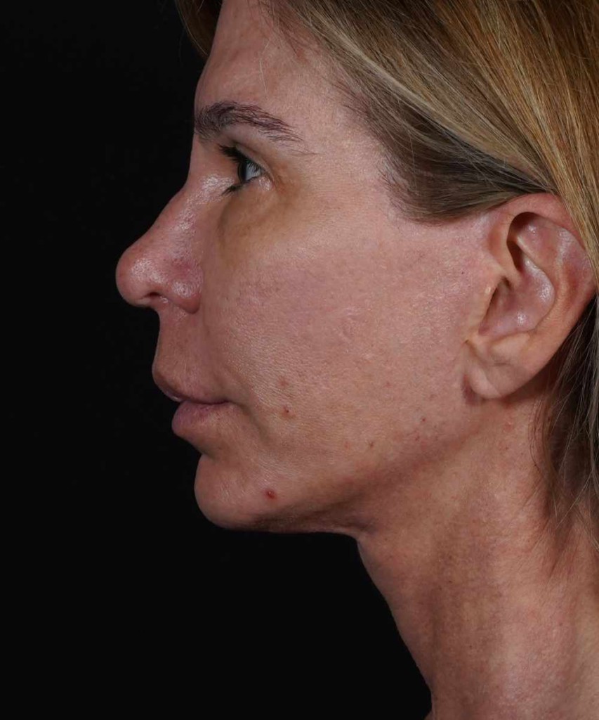 Before lateral
