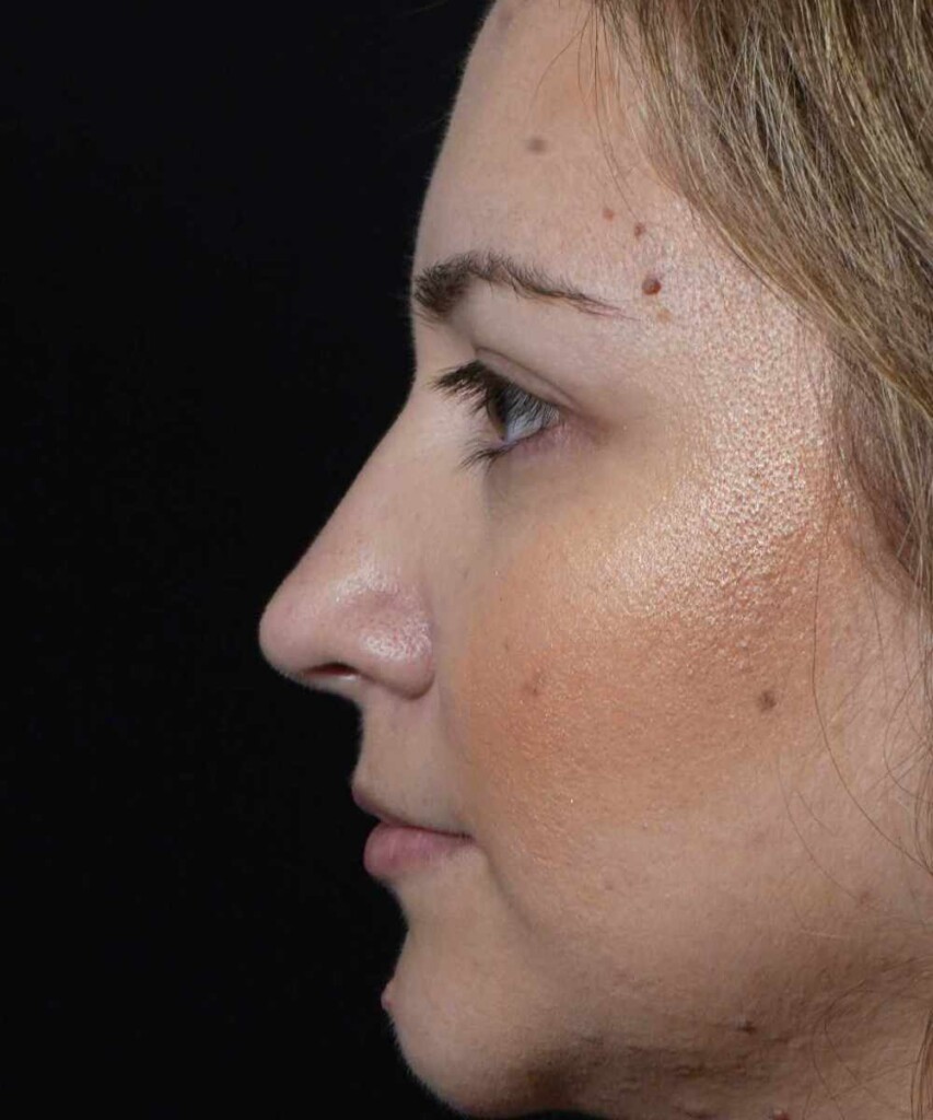 After lateral