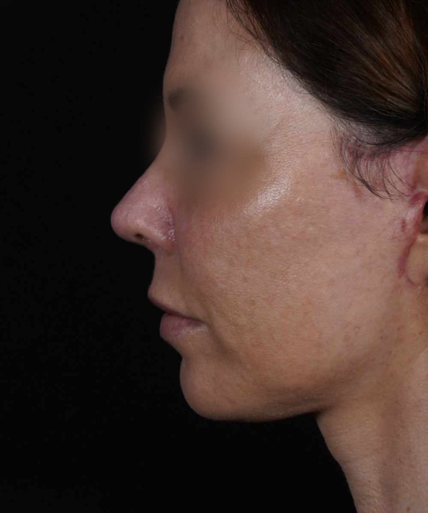 After lateral