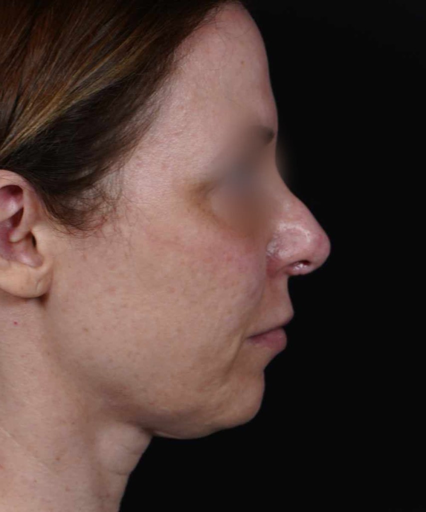 Before lateral right