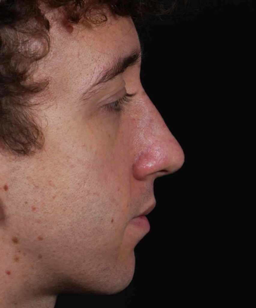 After lateral