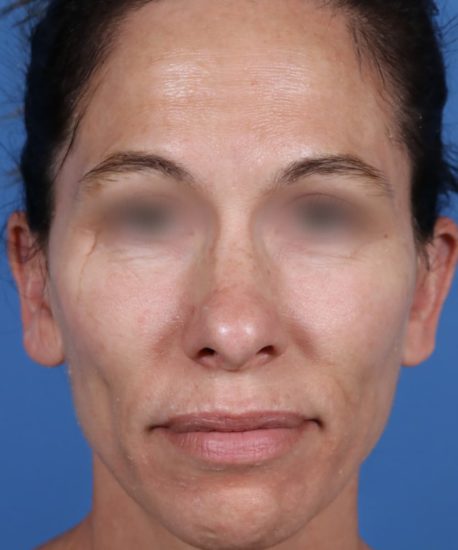 Before frontal