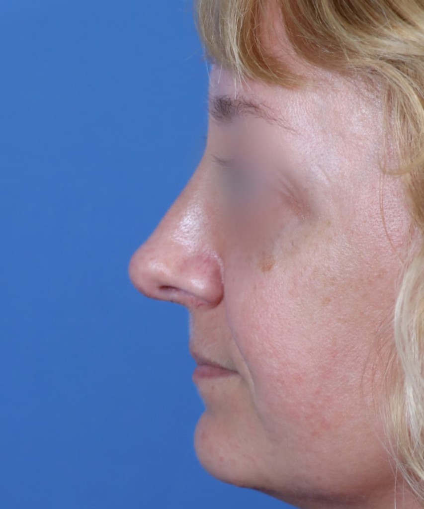 After lateral