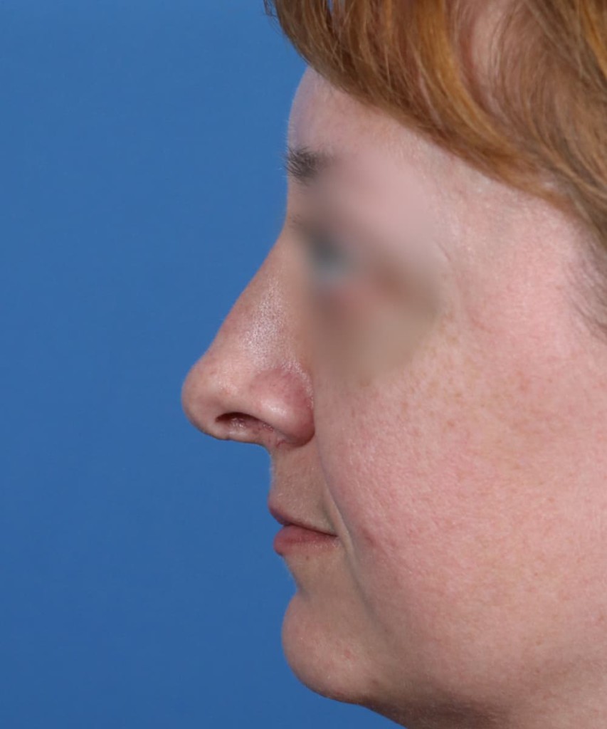 Before lateral