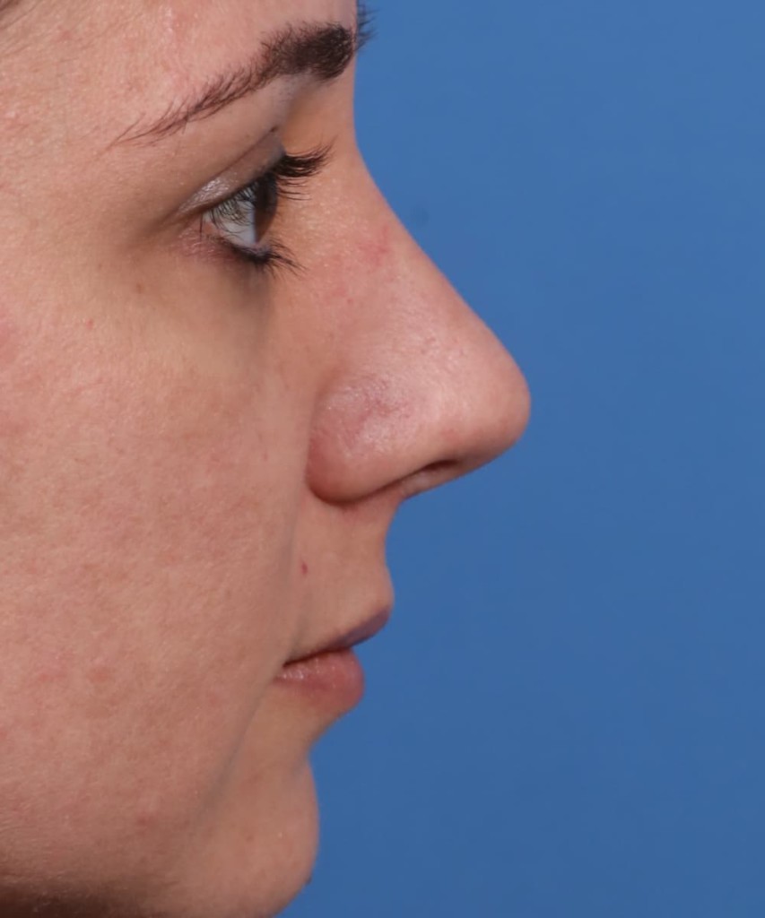After lateral
