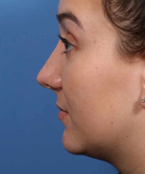 After lateral