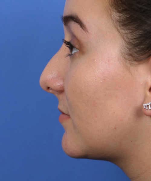 Before lateral