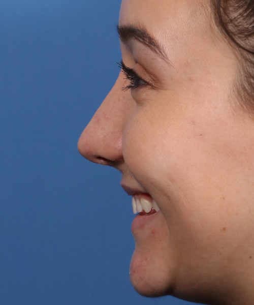 After lateral smiling