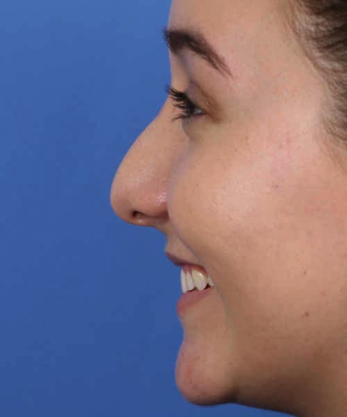Before lateral smiling