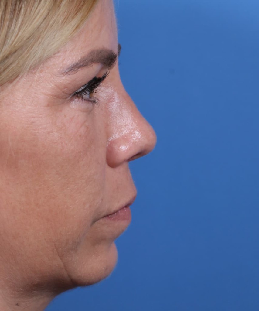 After lateral