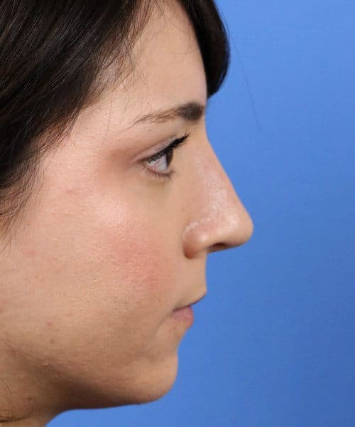 After lateral
