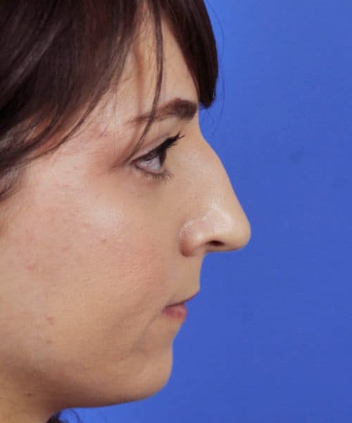 Before lateral