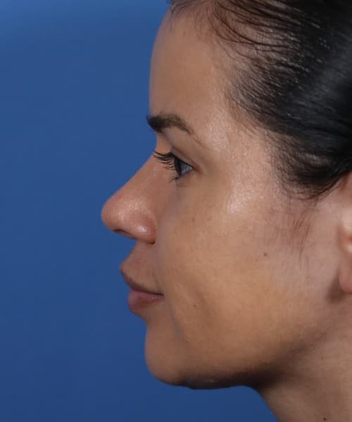 After lateral