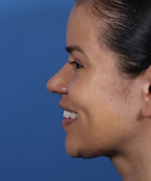 After lateral smiling