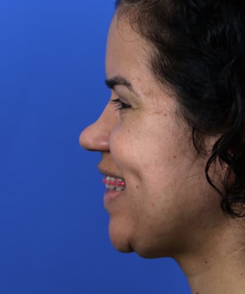 Before lateral smiling