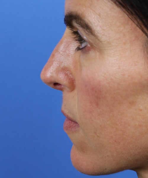 After lateral