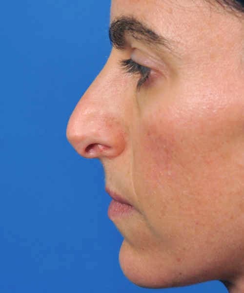 Before lateral