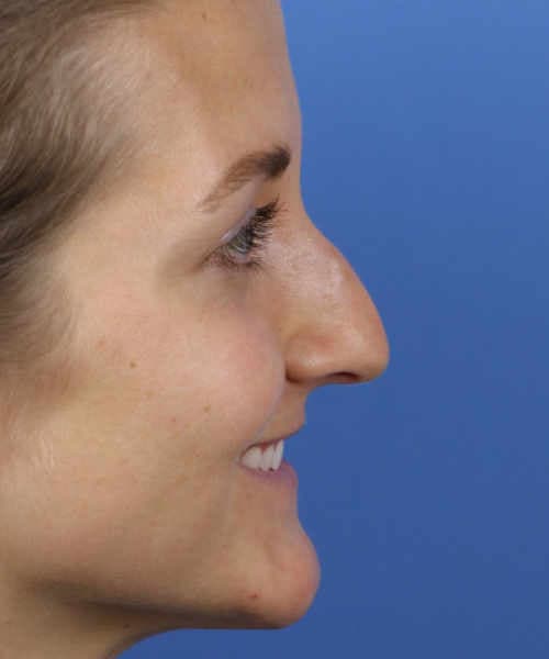 Before side smiling