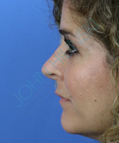 After lateral