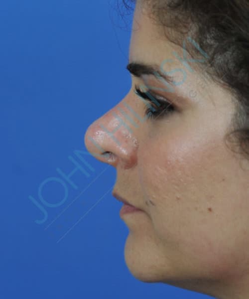 Before lateral