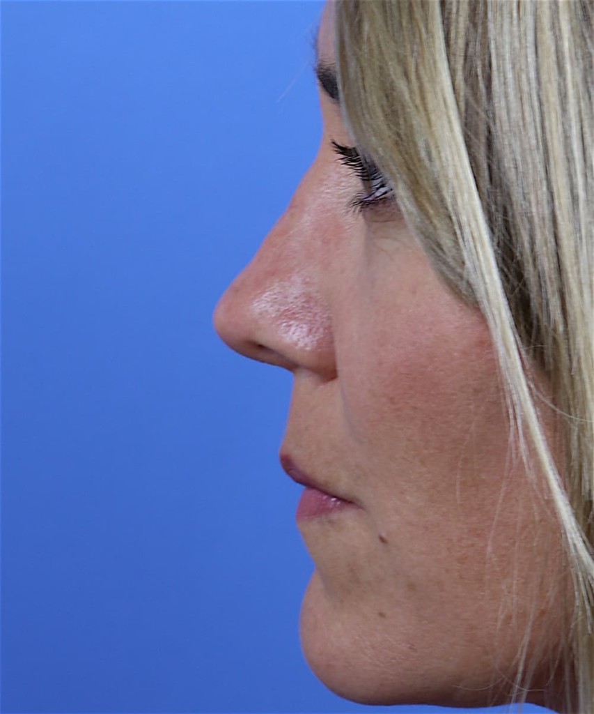 After lateral