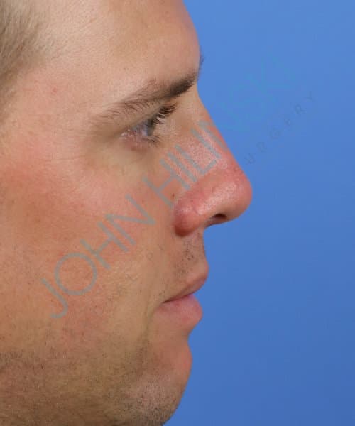 After lateral