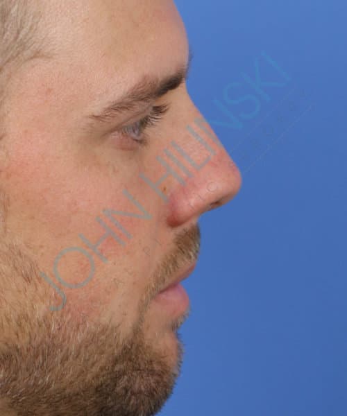 Before lateral