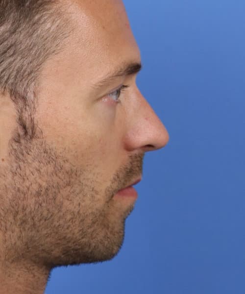 After lateral