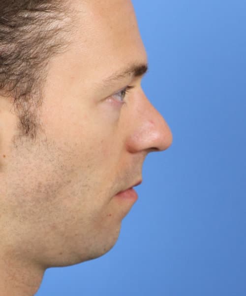 Before lateral