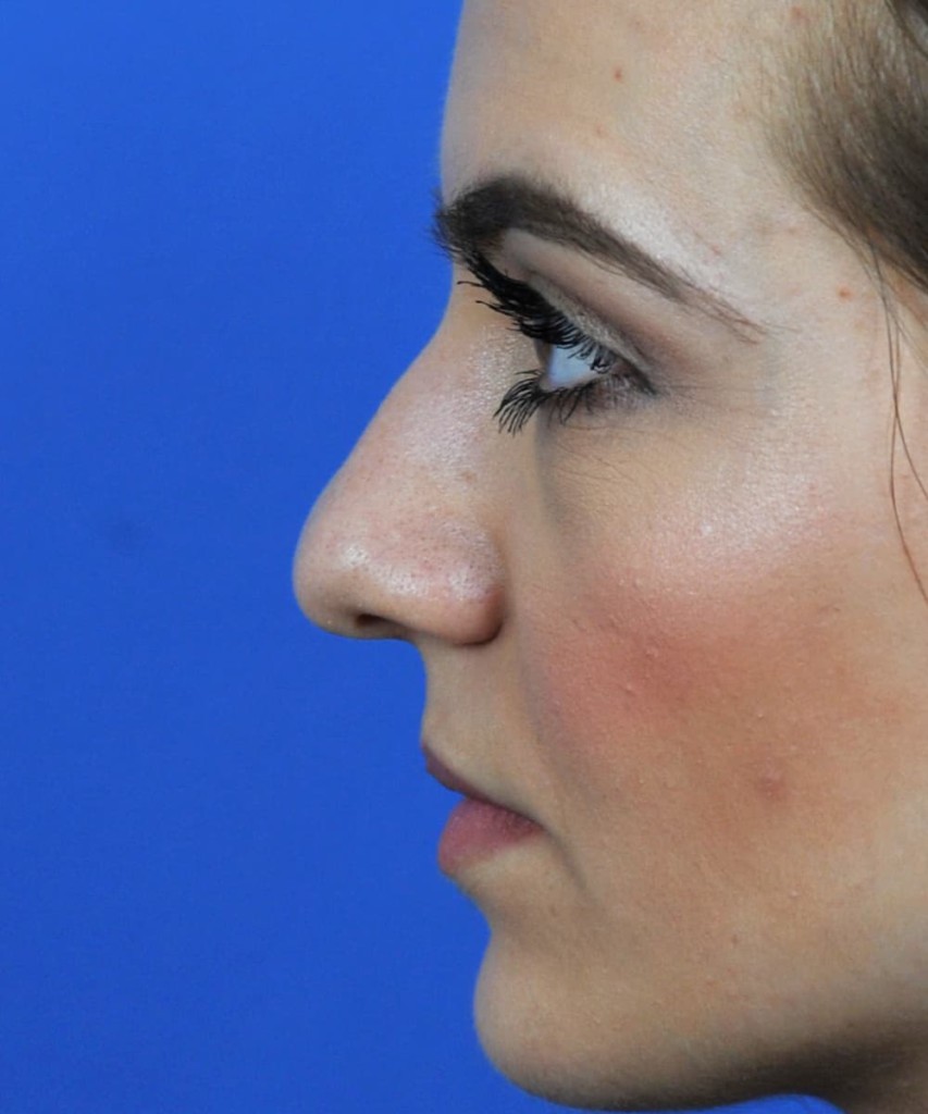 Before lateral