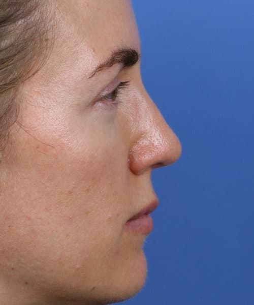 After lateral