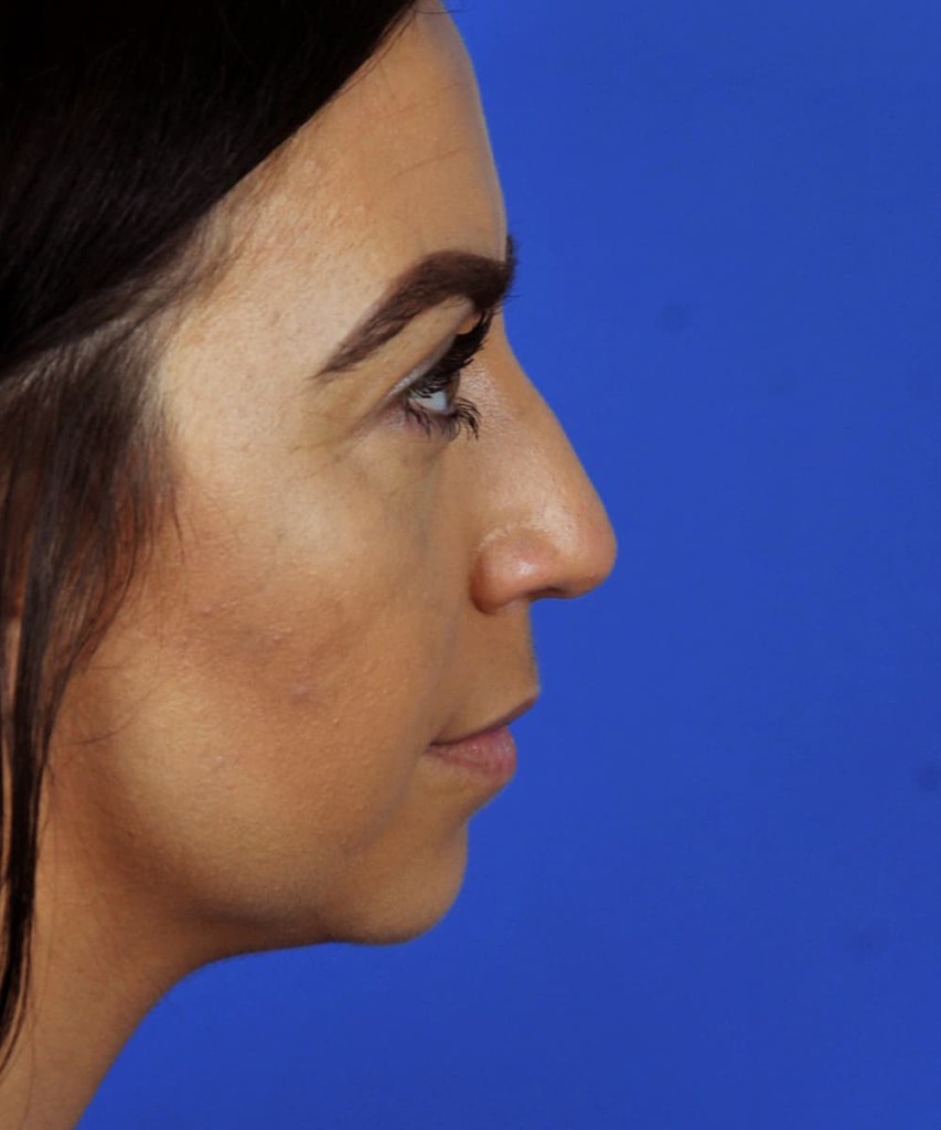 Before lateral