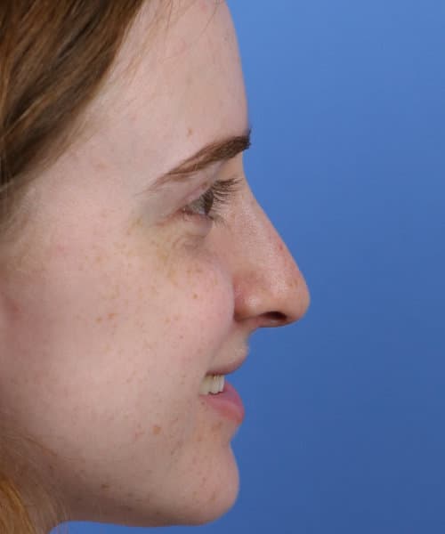 After lateral smiling
