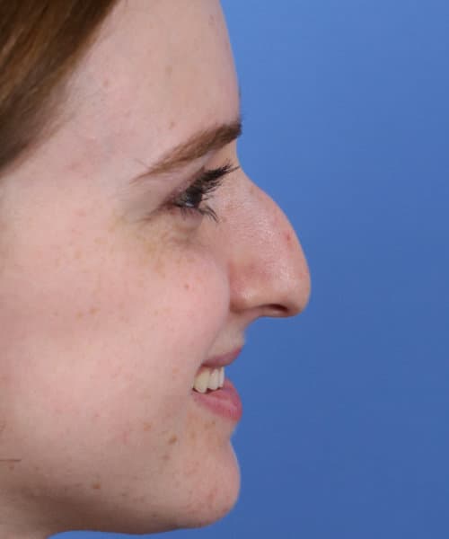 Before lateral smiling