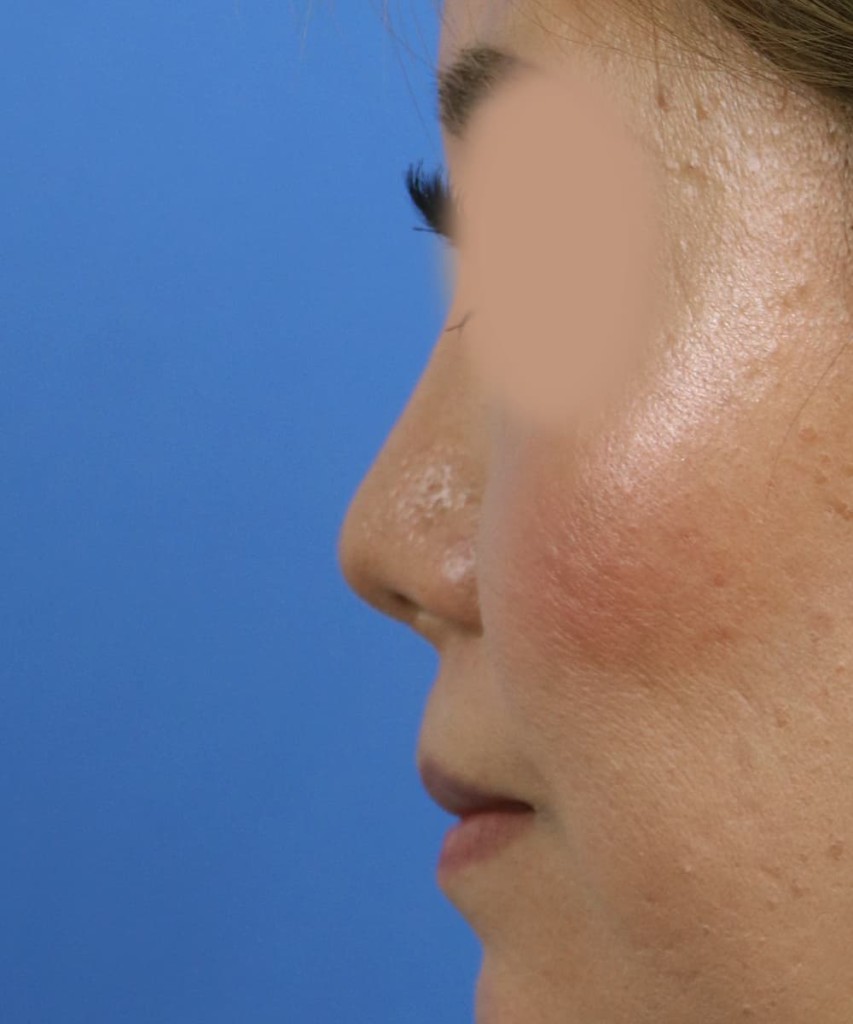 After lateral