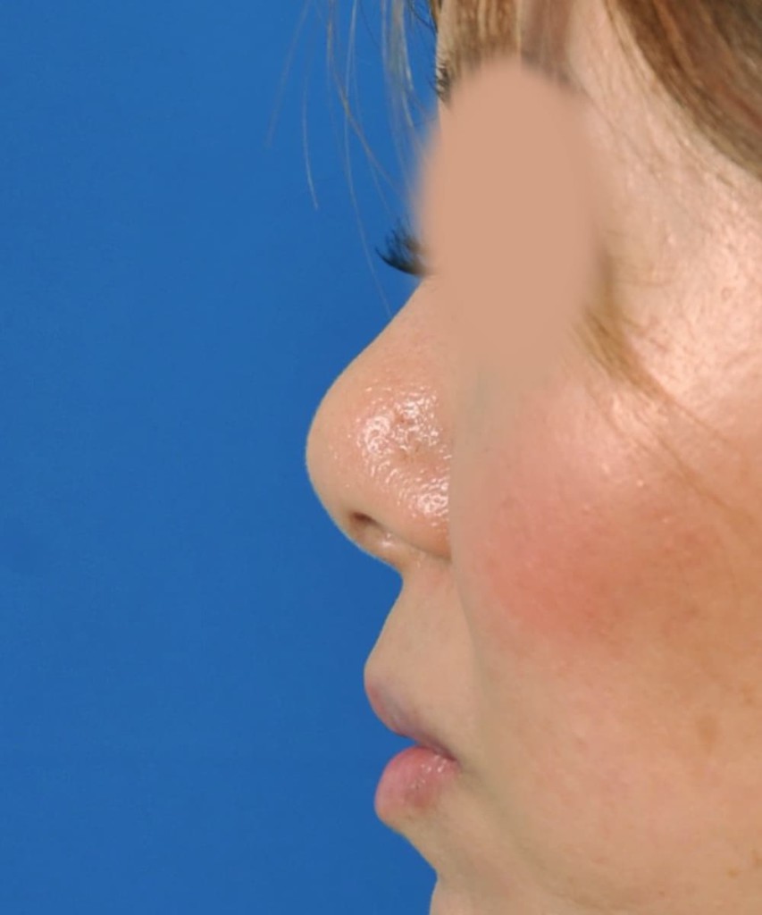Before lateral