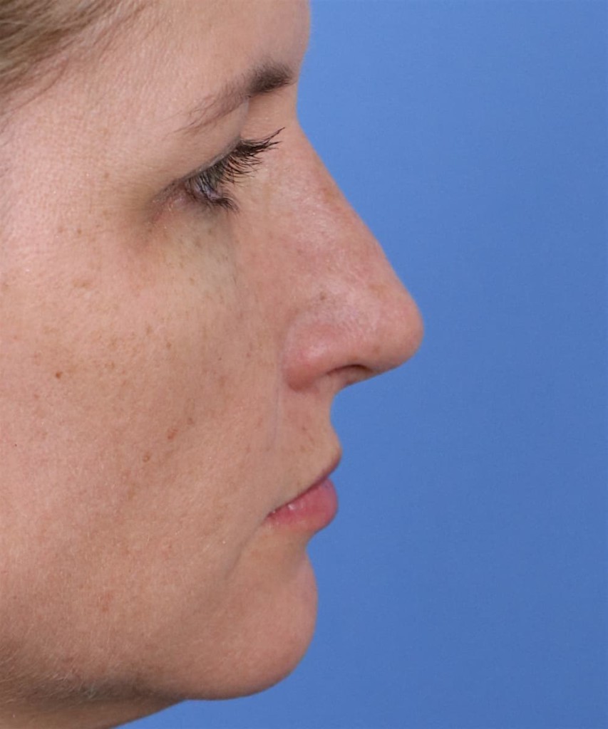 After lateral