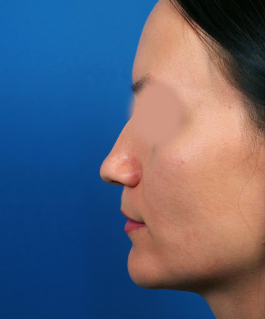 Before lateral