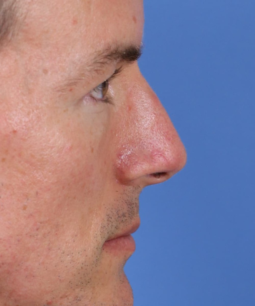 After lateral
