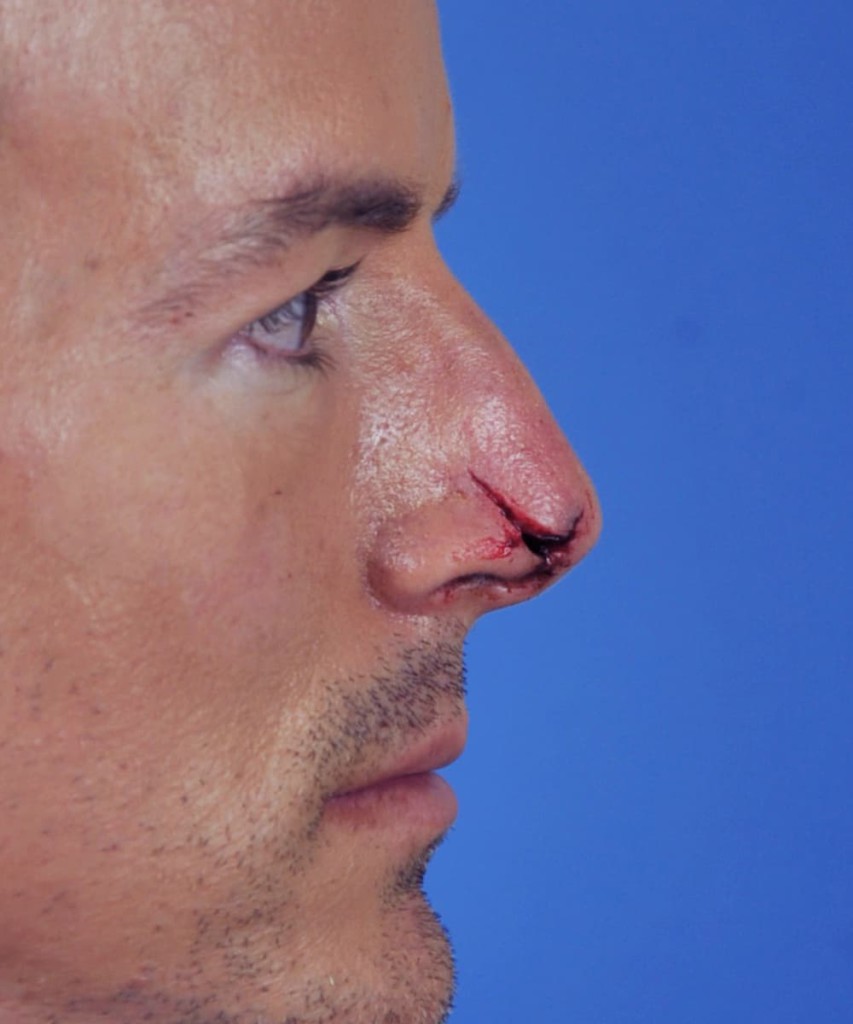 Before lateral