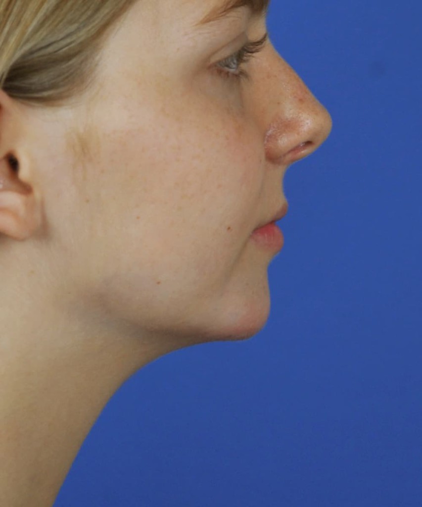 After lateral