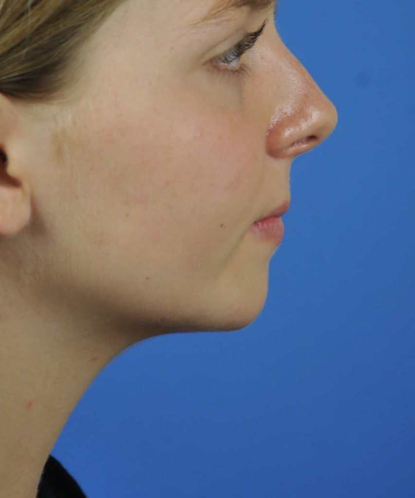 Before lateral