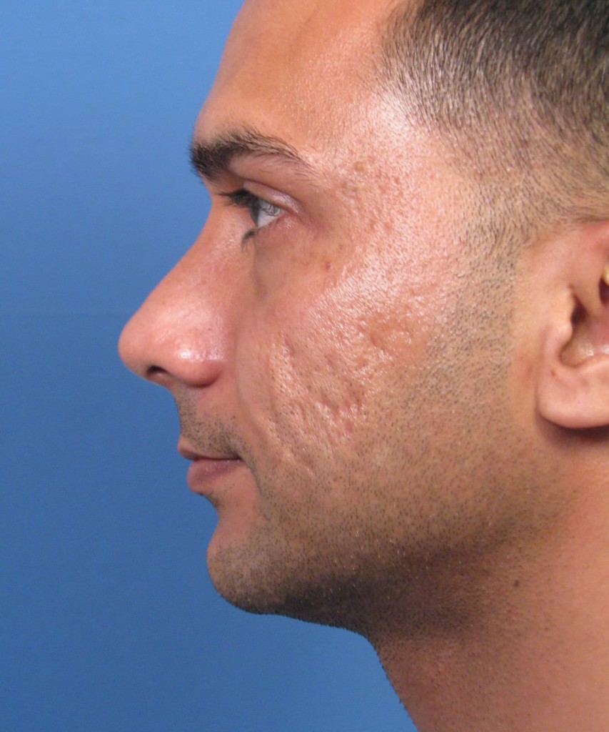 After lateral
