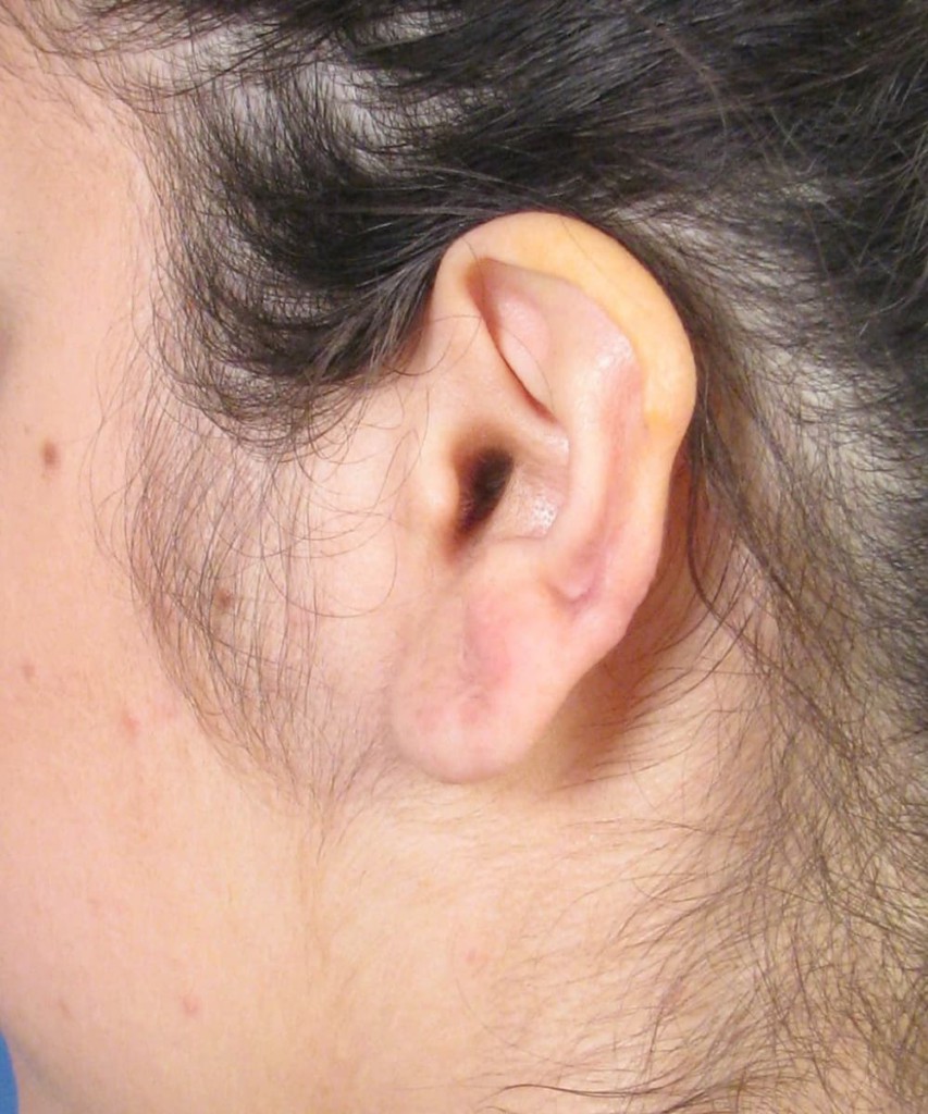 After posterior oblique