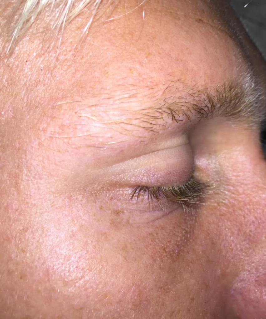 After lateral healed