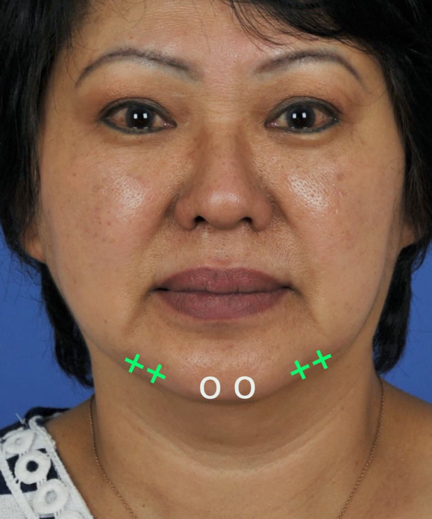 After frontal diagram